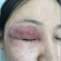 西安交通大學(xué)第二附屬醫(yī)院皮膚病院CPC
